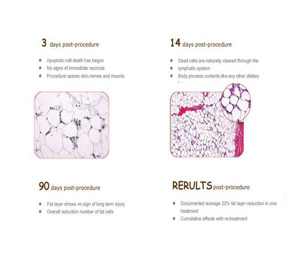 Portable Criolipolisis