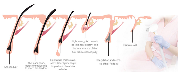 Diode Laser Hair Removal Machine