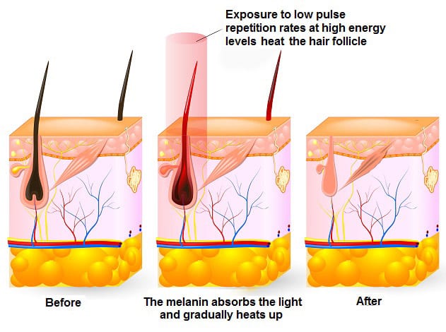 How to distinguish IPL, OPT, DPL