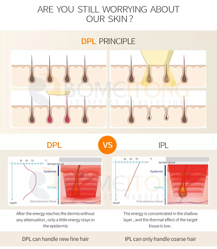 How to distinguish IPL, OPT, DPL