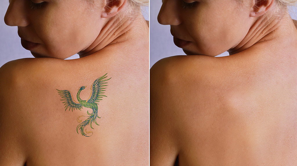 Important factors to consider when evaluating the best laser tattoo removal machine to buy