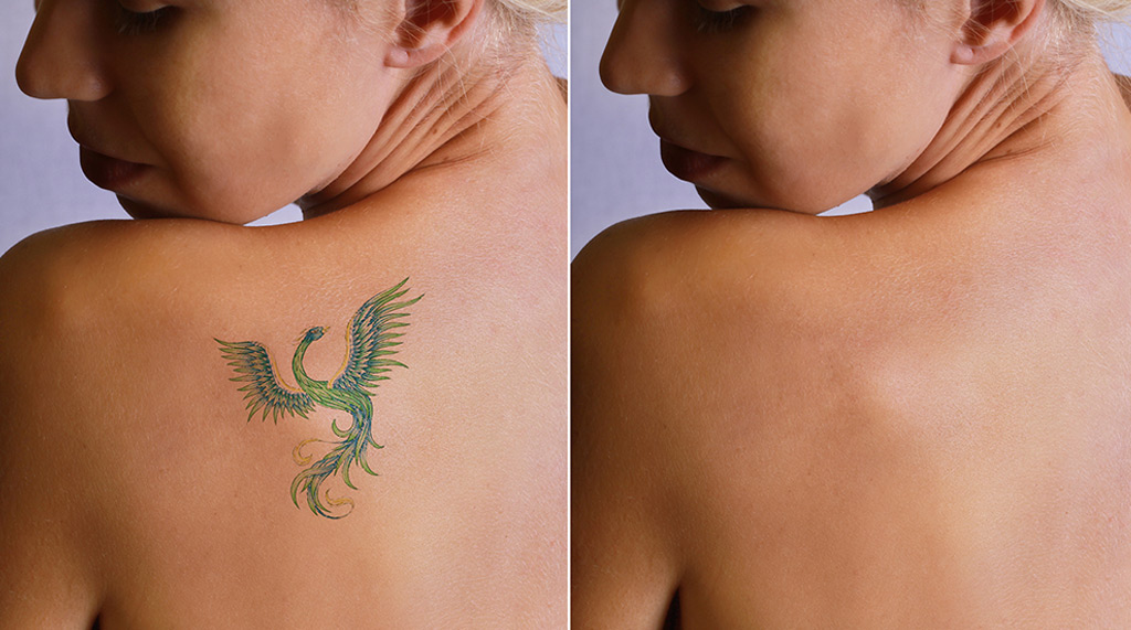 Important factors to consider when evaluating the best laser tattoo removal machine to buy