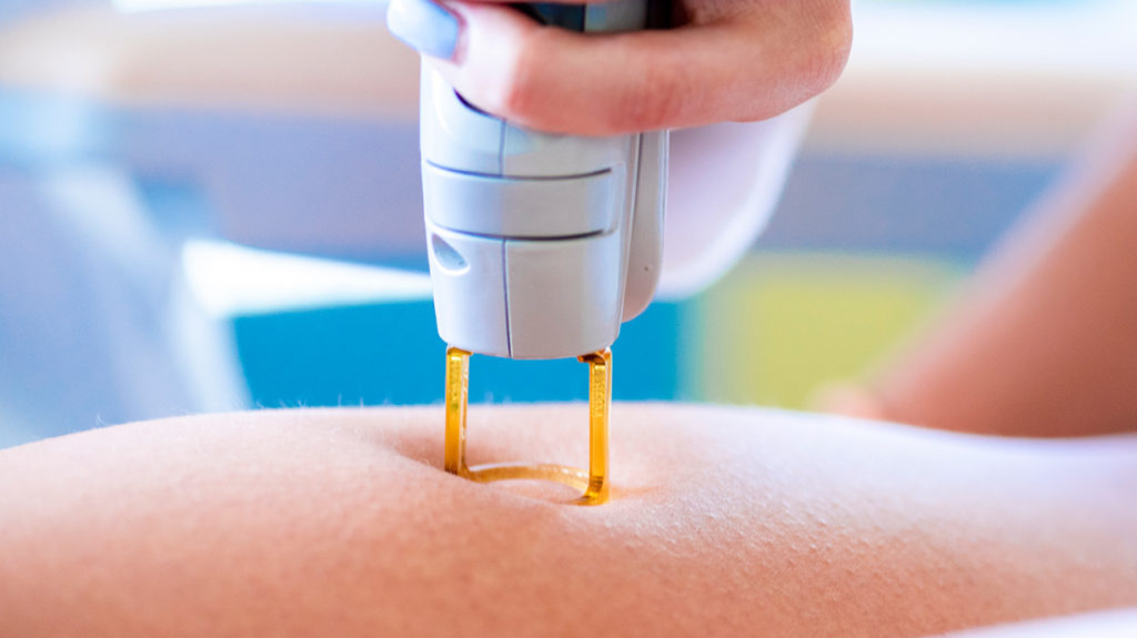 Does home DIY laser hair removal really work?