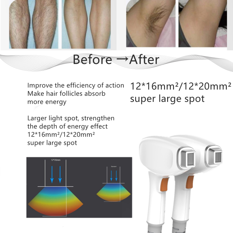 diode laser hair removal machine