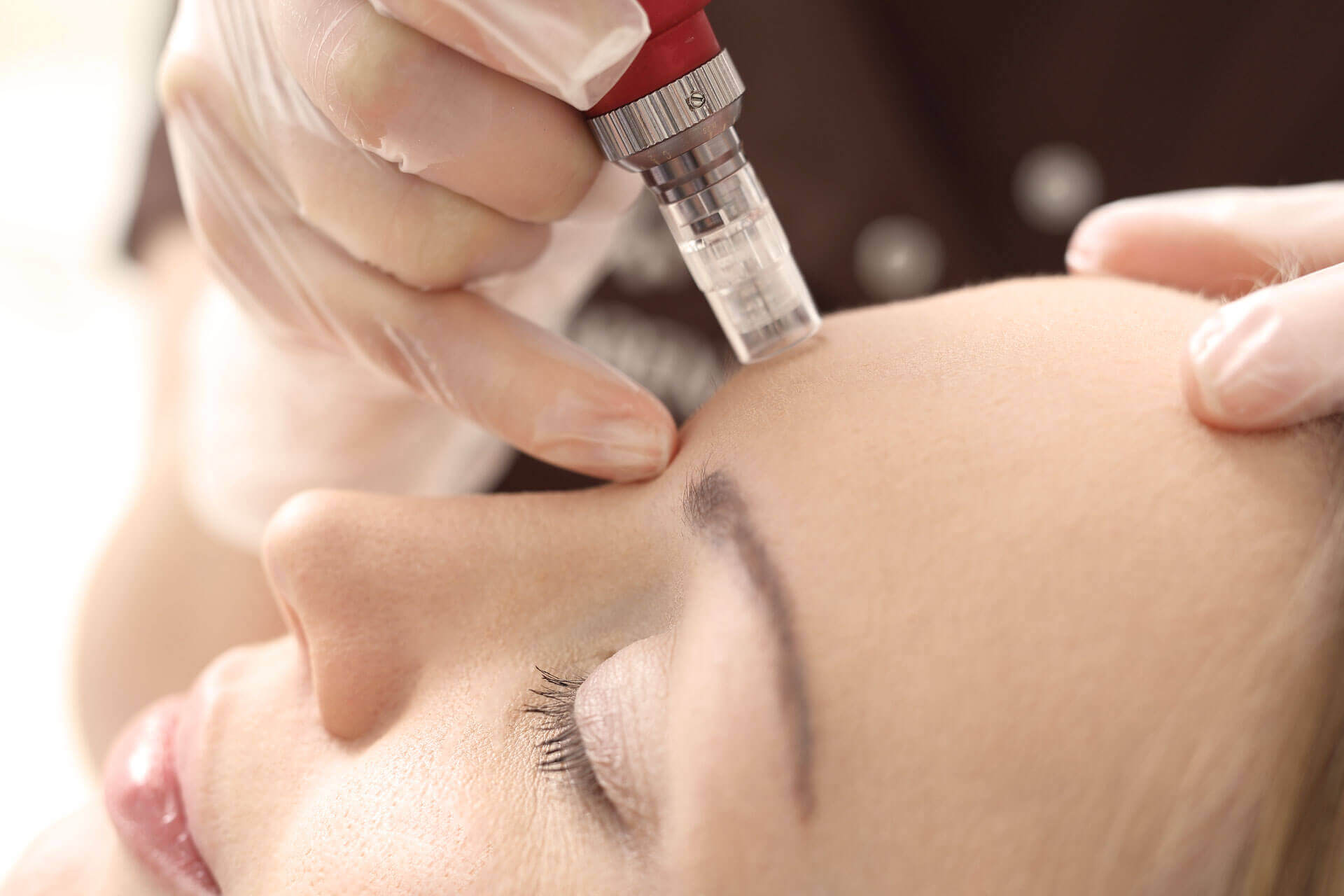 How does microneedling work?