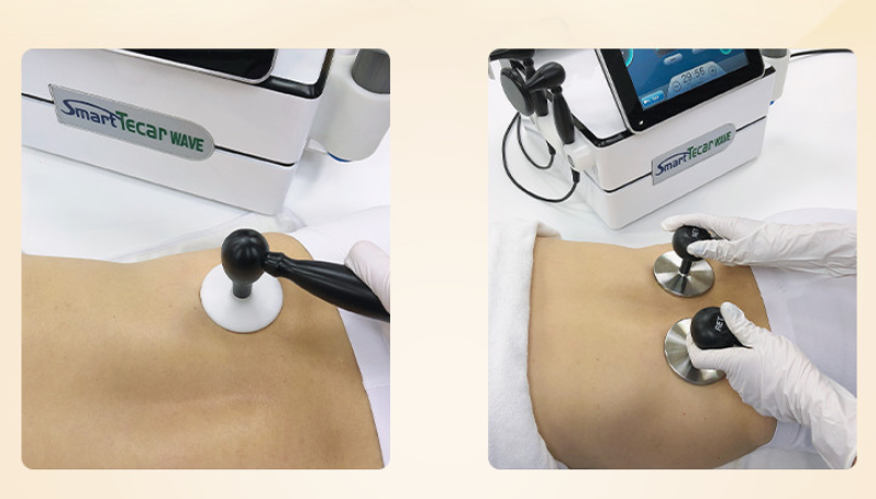 What You Didn't Know About Shockwave Therapy