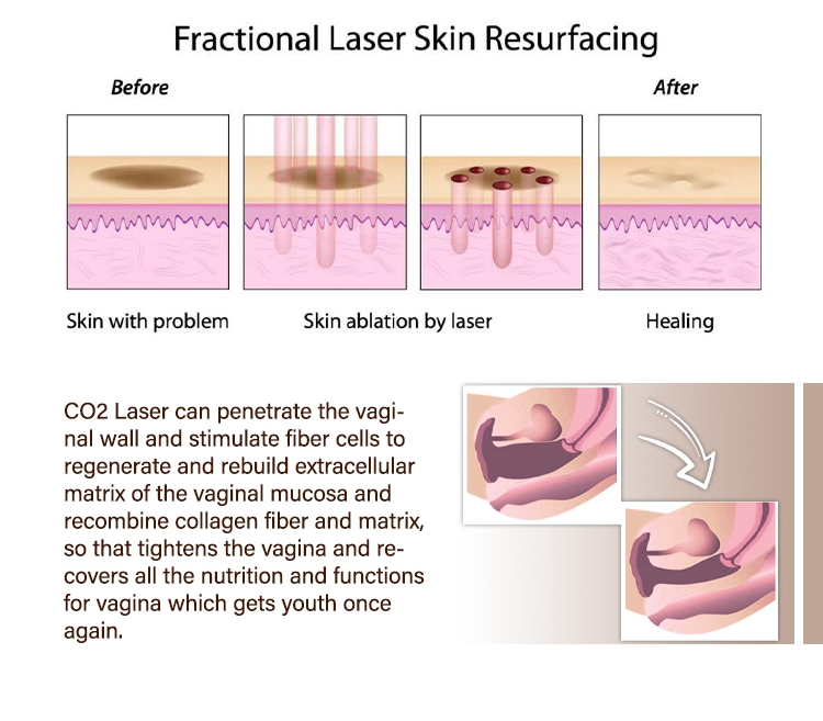 Portable Fractional CO2 Laser Machine