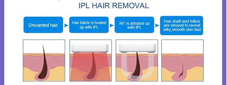 2 in 1 IPL