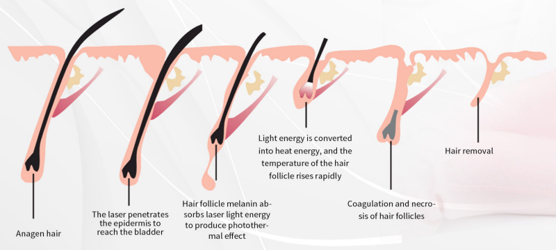 oem 808nm diode laser hair removal