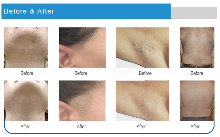 Before and After Diode Laser Hair Removal Equipment