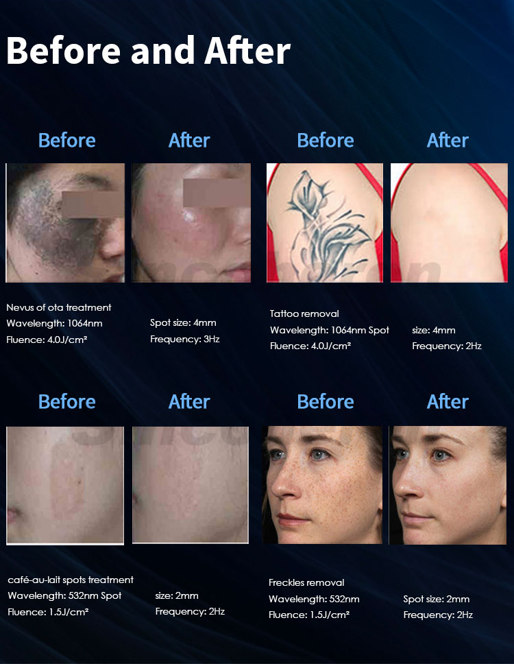 New Portable Pico Laser Tattoo Removal Skin Resurfacing Factory Machine