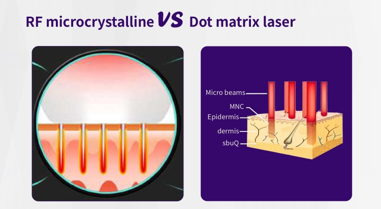 4D HIFU 3 In 1 Radar Carving RF Microneedle Lifting Machine