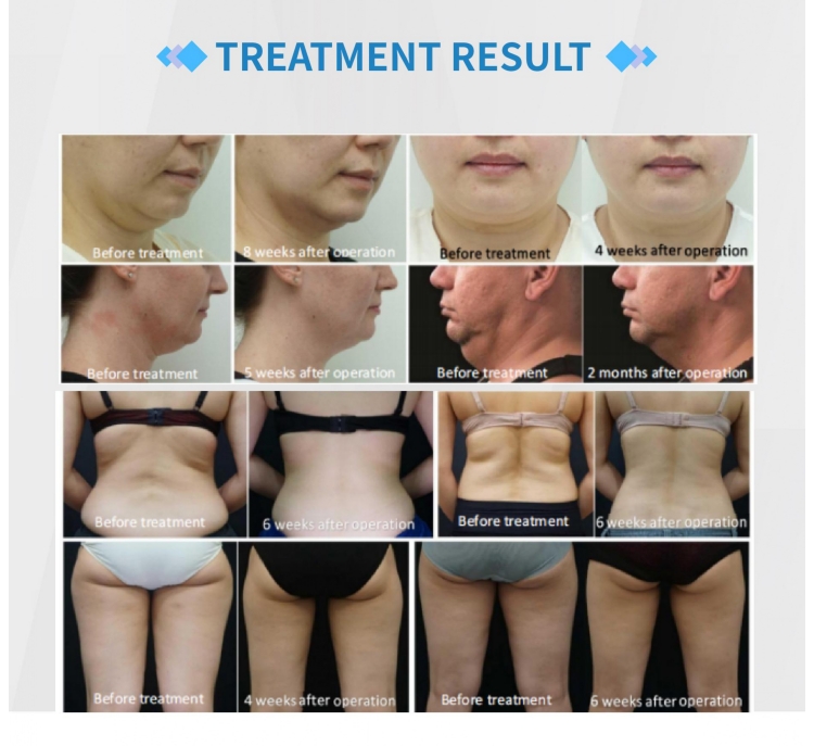 Cryolipolysis 360° Fat Sculpting 4 Handles Machine