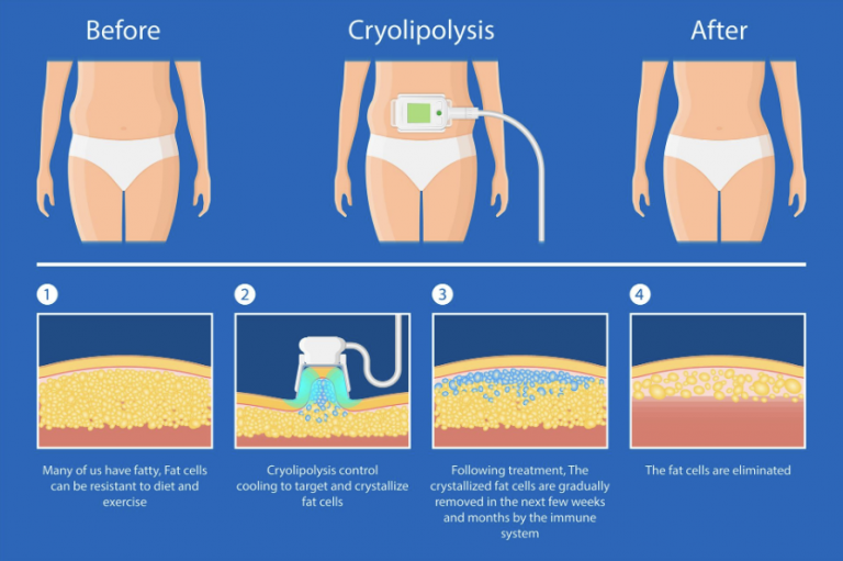 Unlocking the Power of Cryolipolysis: Your Guide to Fat Reduction