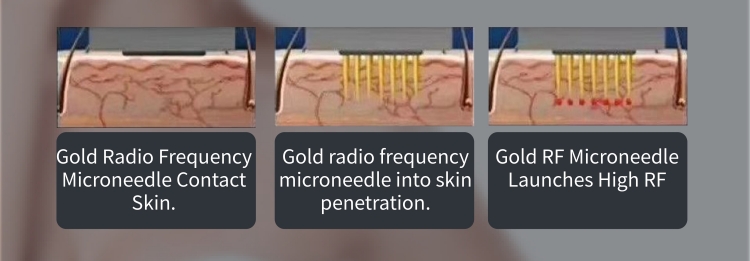 3 In 1 Microneedle RF Acne Removal Cold Hammer Machine