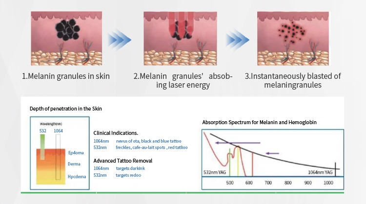 Pico Laser Tattoo Removal Equipment