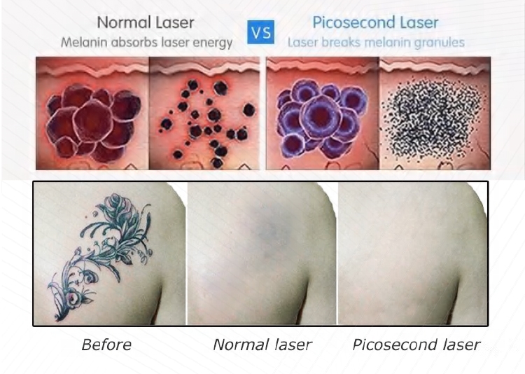 Pico Laser Skin Theary Tattoo Removal Machine