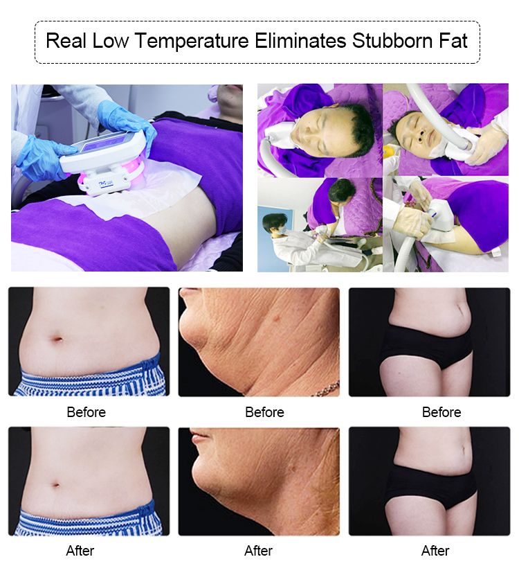 5 In 1 Cryoshape Fat Freezing Machine