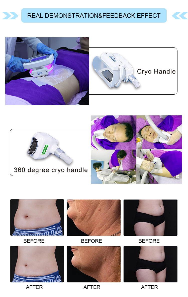 5 Handles Cryolipolysis Fat Removal Machine