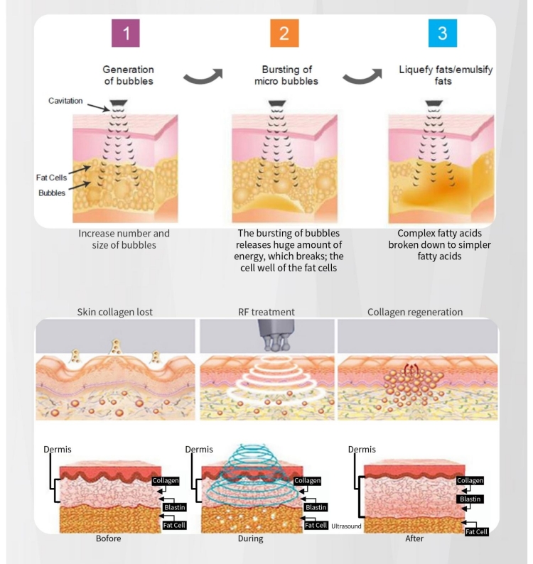 6 In 1 Ultra-Box RF Cavitation Macine