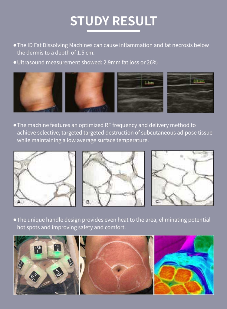 Monopolar RF ID Fat Dissolving Machine