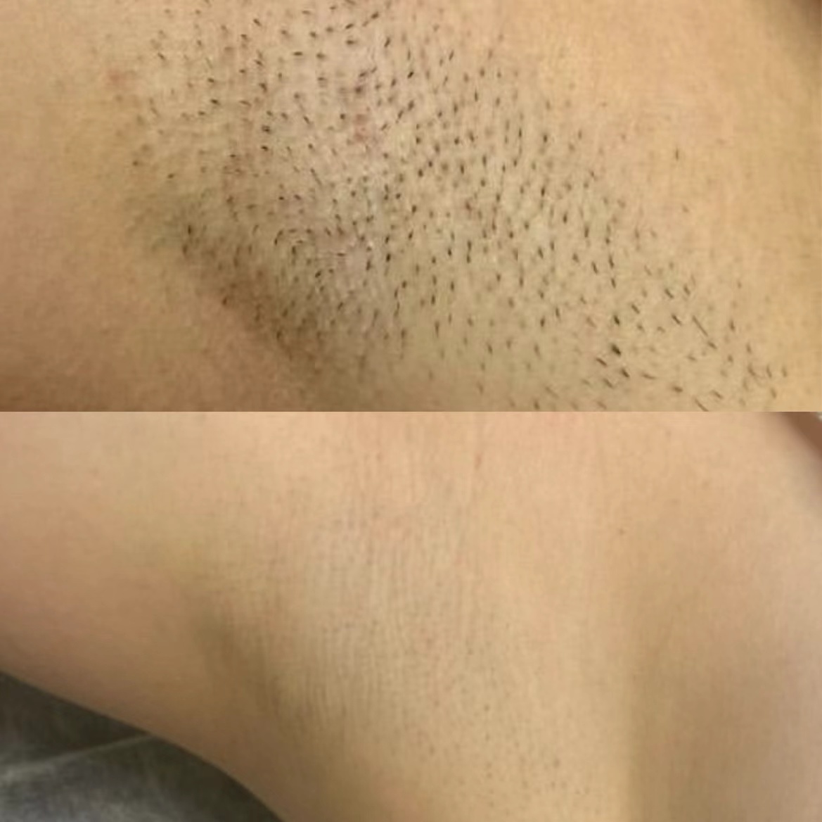 How many sessions of Alexandrite laser are needed?