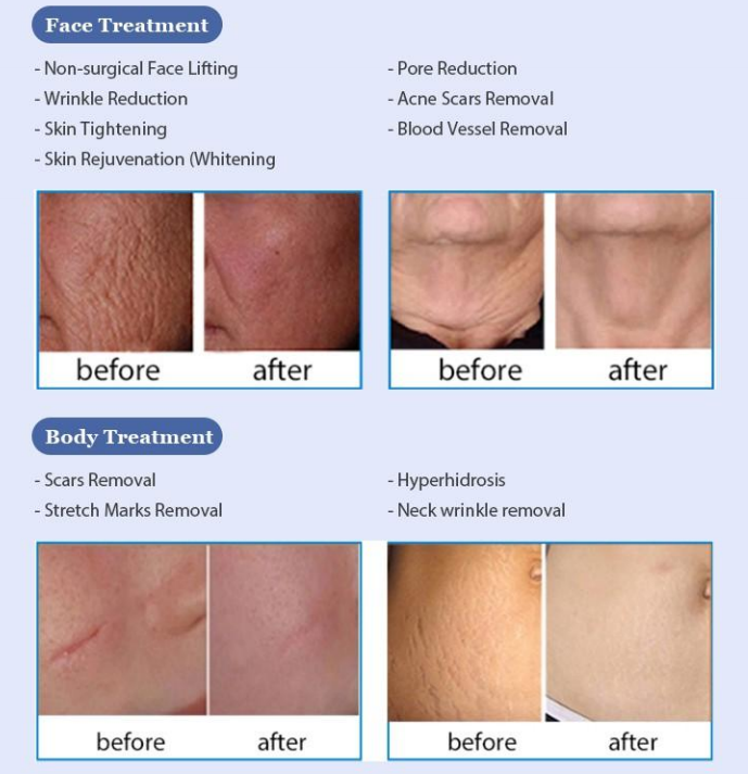 Does RF microneedling make you look younger?