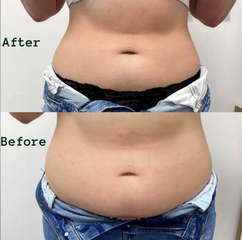 How many sessions of cryolipolysis is needed?
