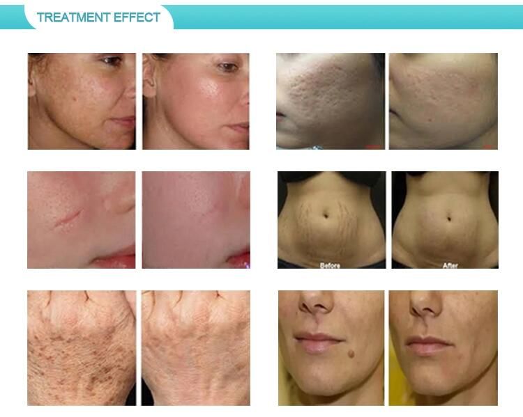 What should you avoid doing before CO2 laser treatment?