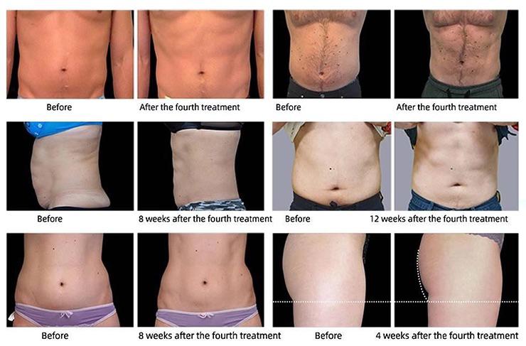 Can HIFEM Reduce Belly Fat?