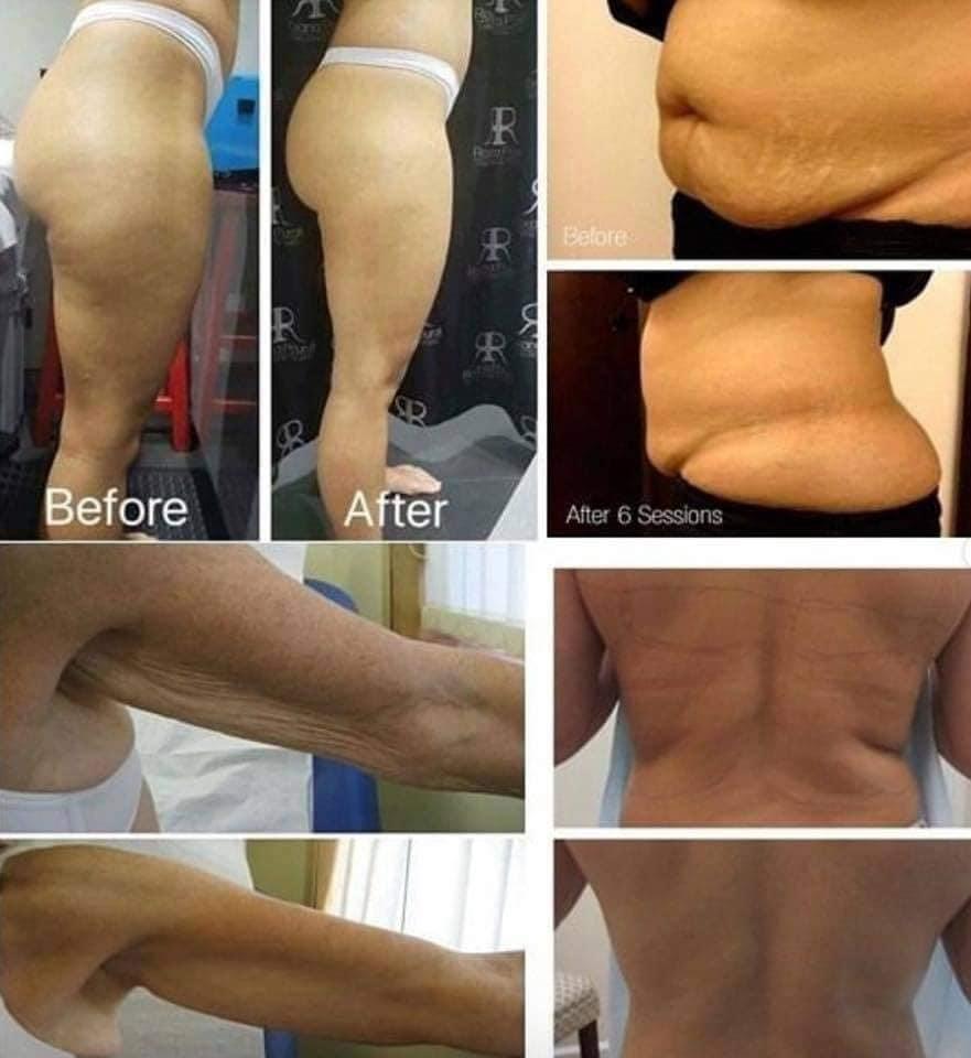 Is KumaShape Painful?