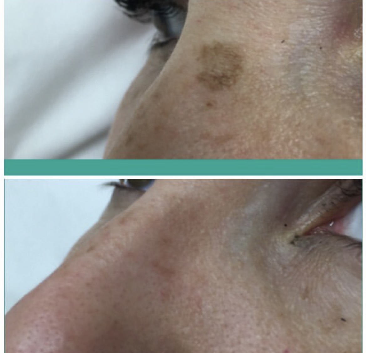 How Long Do Q-Switched Nd:YAG Laser Treatment Results Last?