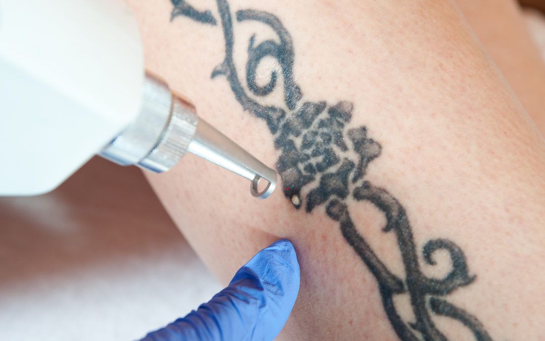 How much is the laser tattoo removal machine?