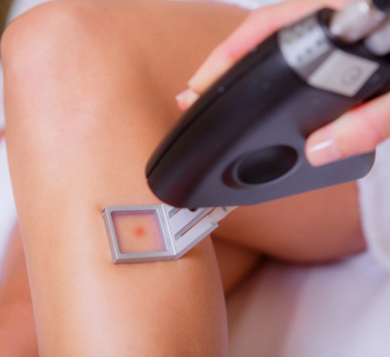 Does home DIY laser hair removal really work?