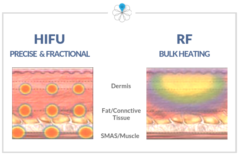 Which is better HIFU or RF?