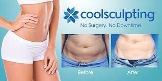 Does Fat Freezing Work? Two Experts Weigh In on CoolSculpting