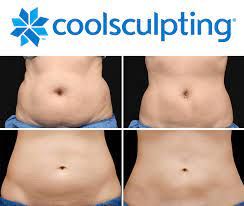 CoolSculpting at Home, Does it useful?