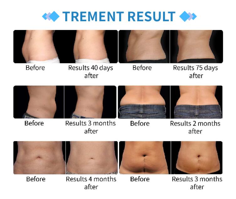 The Slim Freeze Fat Reduction Freezer comes equipped with precision applicators designed to target specific areas of concern. Whether you want to reduce love handles or sculpt your waistline, these applicators ensure optimal contact and effective fat reduction in the desired area.