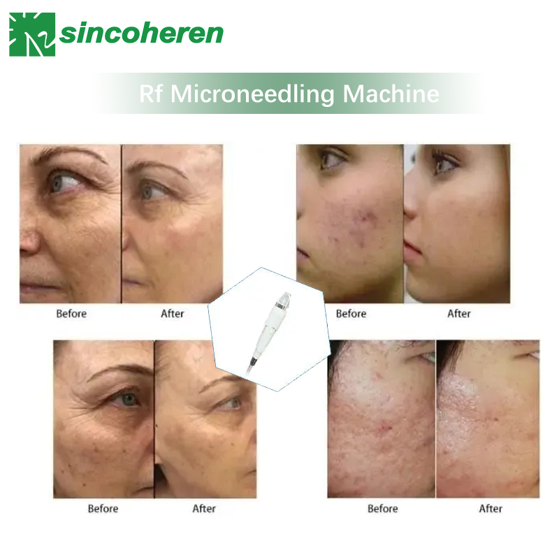 Microneedle Fractional RF Machine