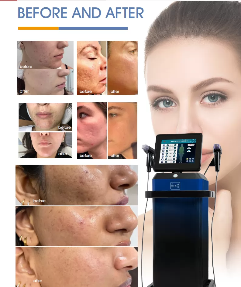 HIFU-Beauty-Machine